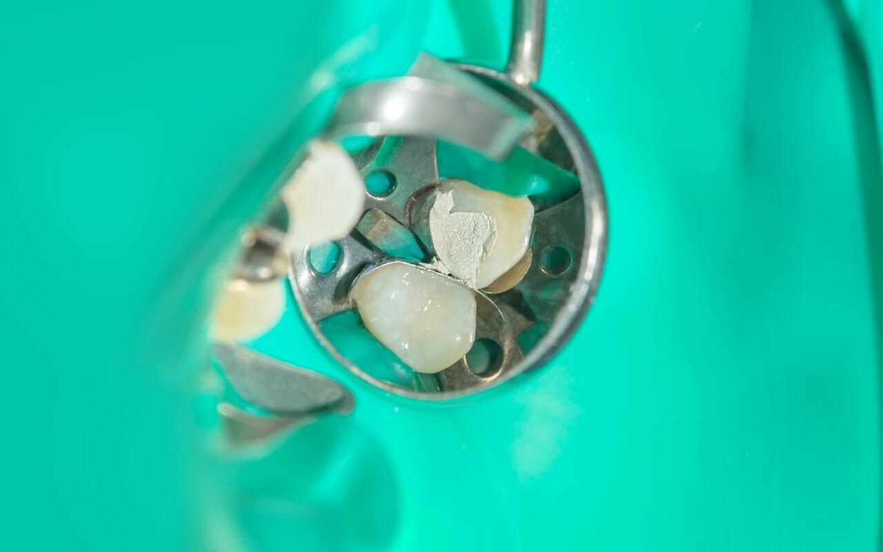 What are Dental Sealants How are Sealants Applied Bradford Family