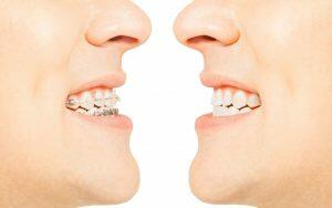 ultimate-guide-to-braces-Bradford-Family-Dentistry
