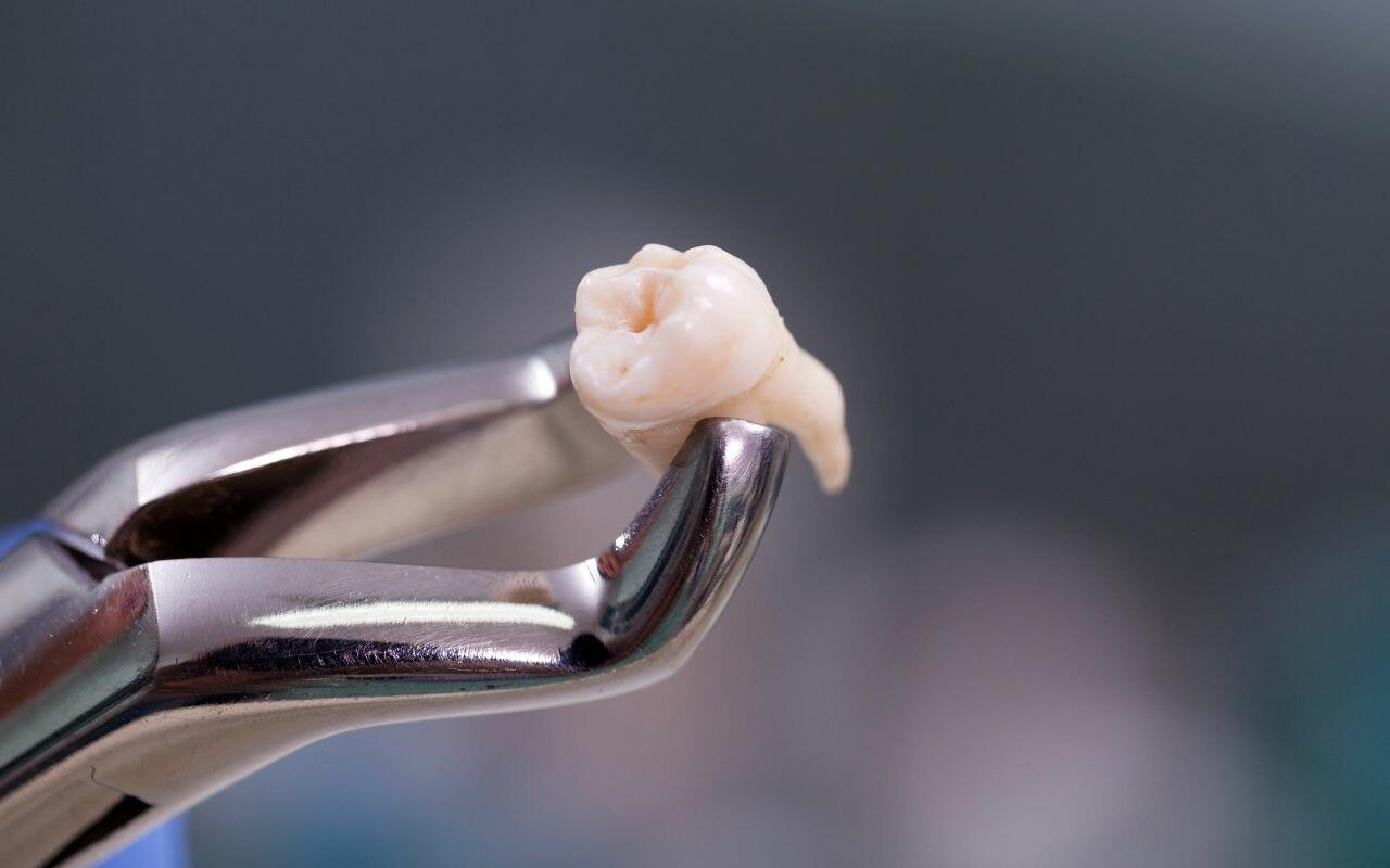 Can I Smoke After A Tooth Extraction? Bradford Family Dentistry
