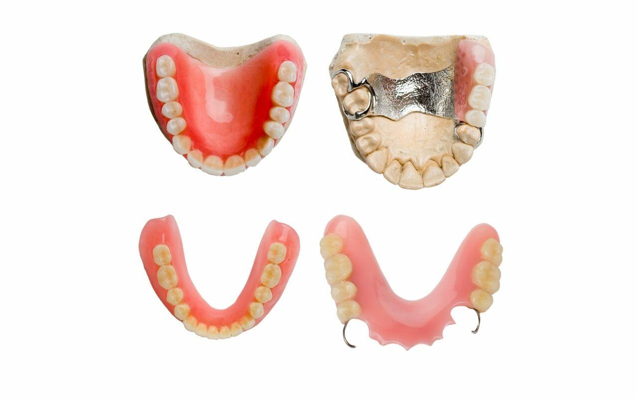 difference-between-bridges-and-implants