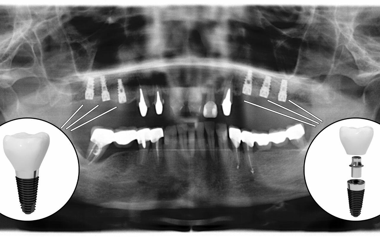 what-are-dental-implants-made-of-Bradford-Family-Dentistry