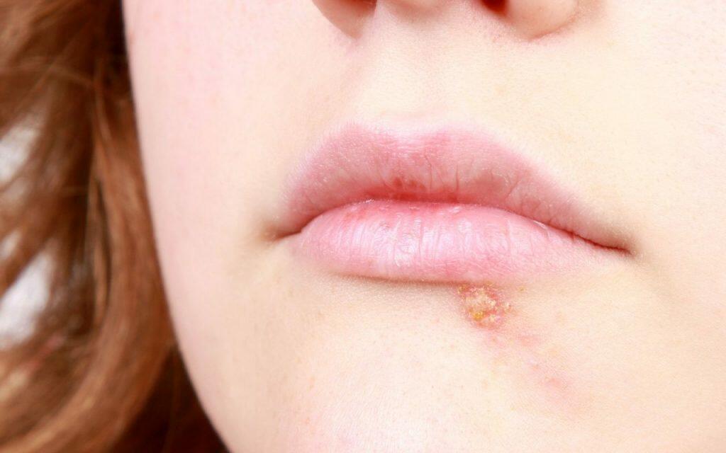 Cold Sores And Their Impact On Your Oral Health Bradford Family Dentistry