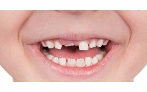 A close up of a child's mouth showing common childhood dental problems with missing teeth.