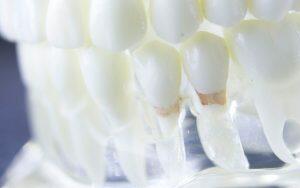 A close up of a model showcasing bleeding gums.