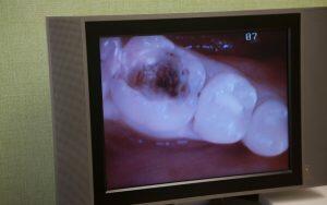 An alarming image of a tooth on a TV screen warns of the dangers of tooth decay.