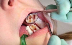 A dental hygienist examines a woman's teeth to assess tooth decay risks.