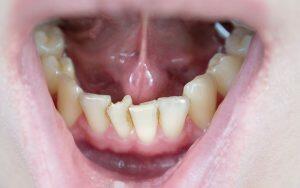 A close up of a person's mouth highlighting the impact of crooked teeth and the transformative power of braces.