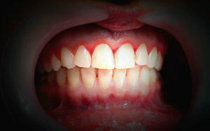 A close up of a person's mouth showing signs of periodontitis.