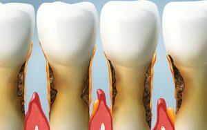 A series of teeth with different stages of periodontitis.