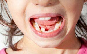 A young girl pictured after braces.