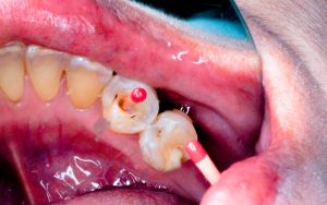 Close-up of a person's open mouth showing two decayed molars with dental instruments inserted into the cavities.