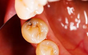 Close-up view of two dental fillings in molar teeth inside a mouth.